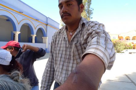 Guadalupe Vásquez Ruiz shows the scars from the gun wound he suffered. Photo by Sara Méndez